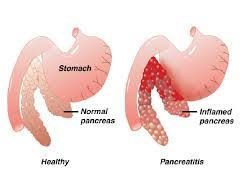 Pancreatitis